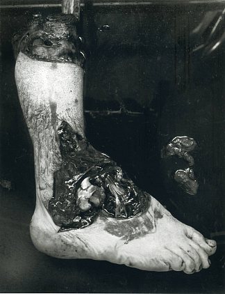 无题（截肢的脚） Untitled (Amputated Foot) (1939; United States                     )，弗雷德里克·索默