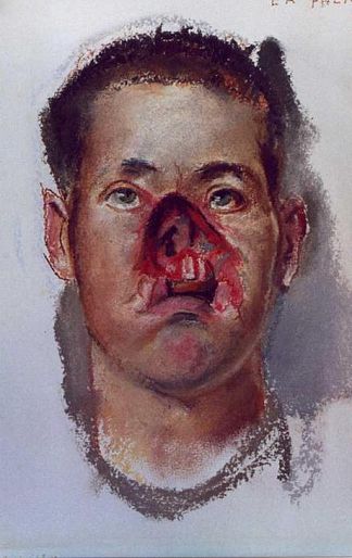 鼻子严重受伤 With Severe Nose Injury (c.1918)，亨利·唐克斯